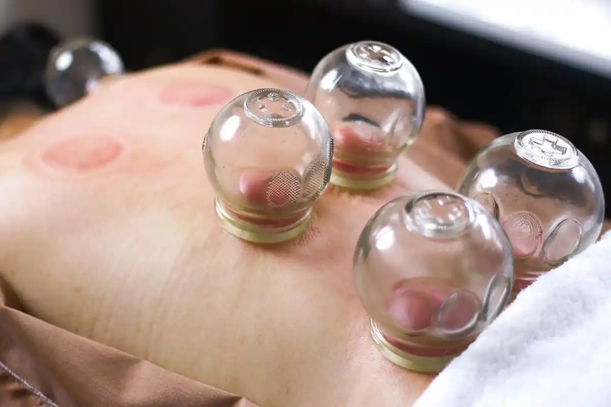 Cupping Therapy